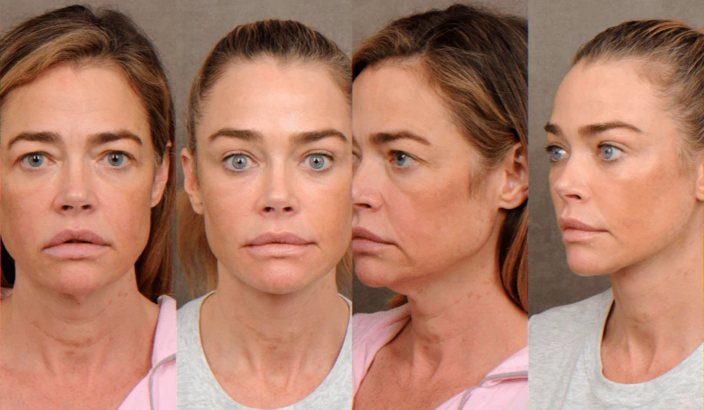 Avant-après restauration discrète relance débat chirurgie esthétique